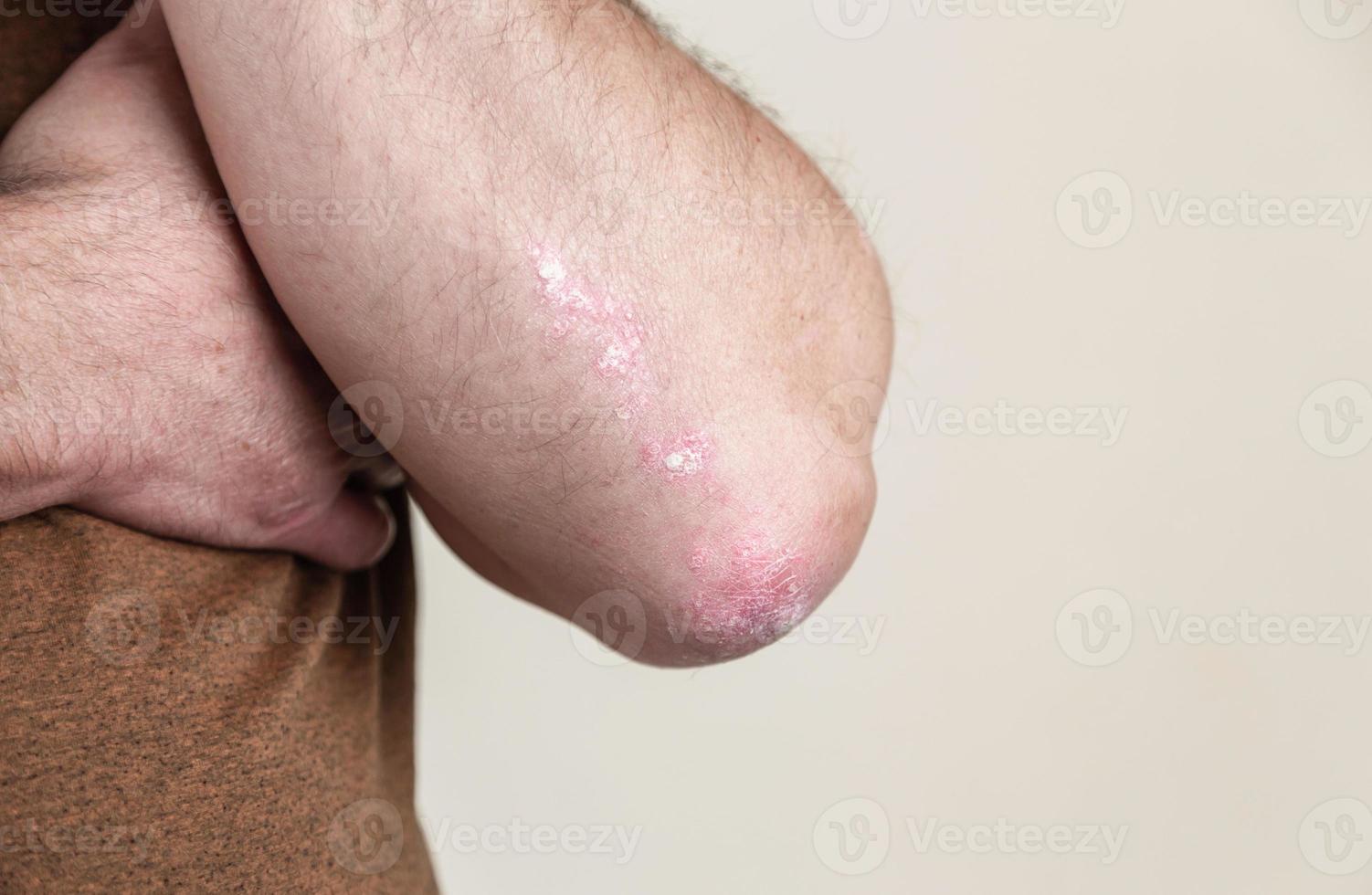 Psoriasis on the elbow photo