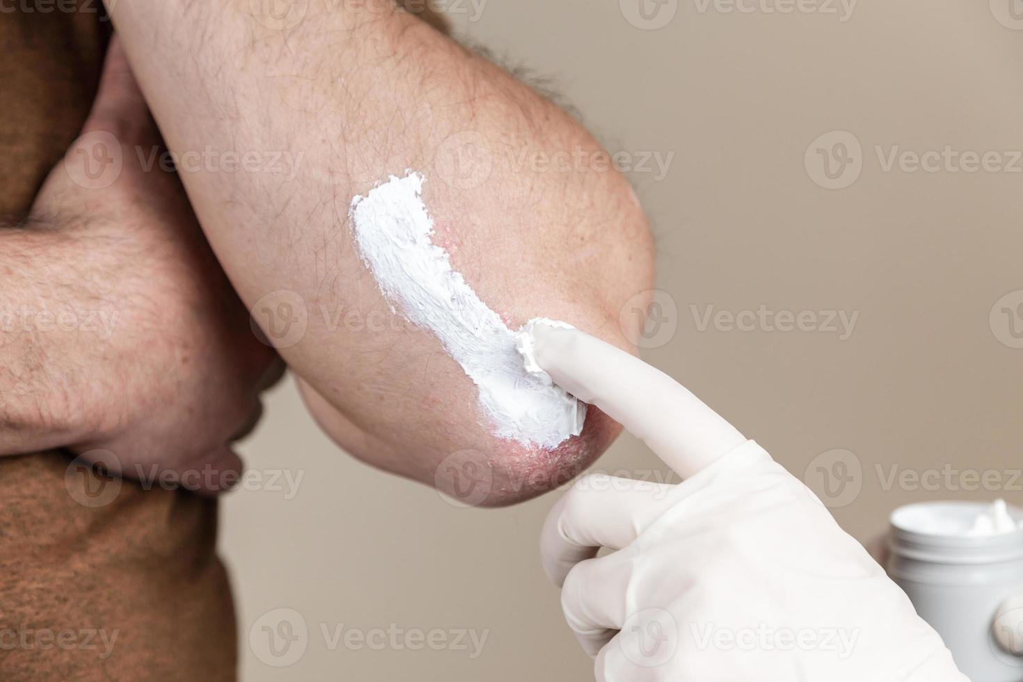 un dermatólogo con guantes aplica una pomada terapéutica a la piel afectada de un paciente con psoriasis foto