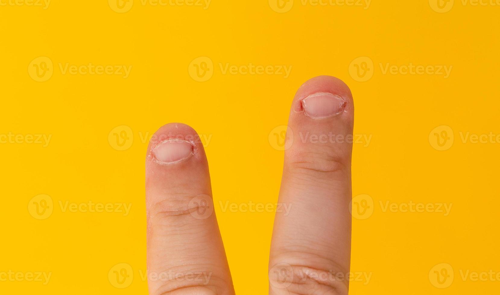 Two fingers with bitten nails isolated on a yellow background photo
