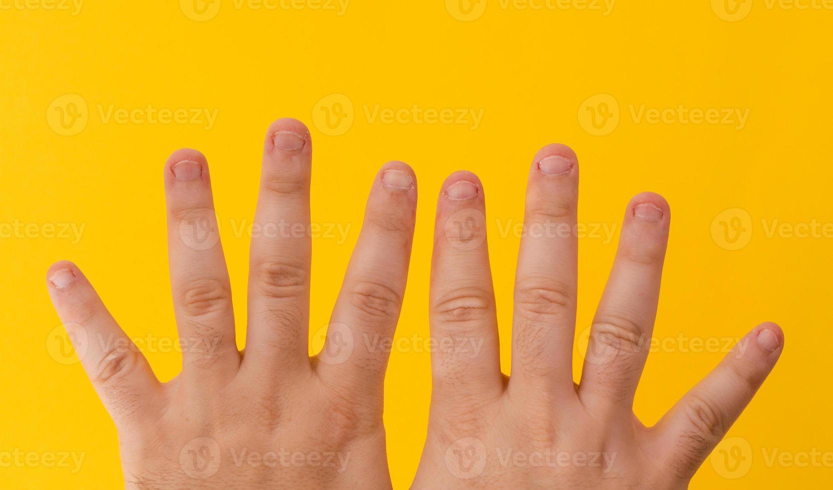 Fingers with bitten nails isolated on a yellow background photo