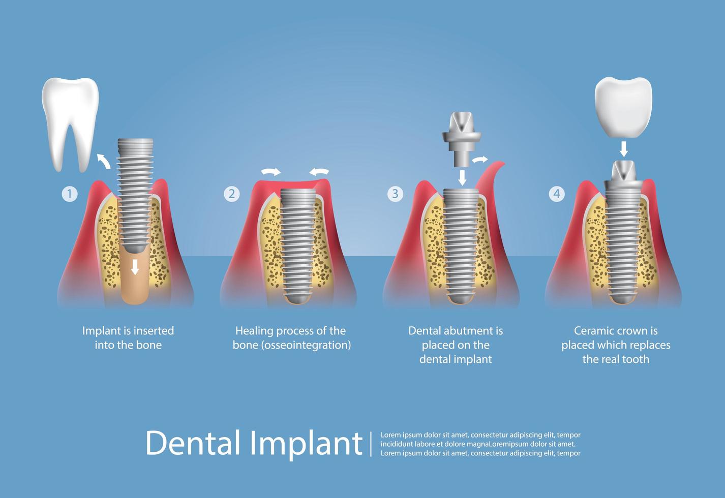 Human teeth and Dental implant set vector
