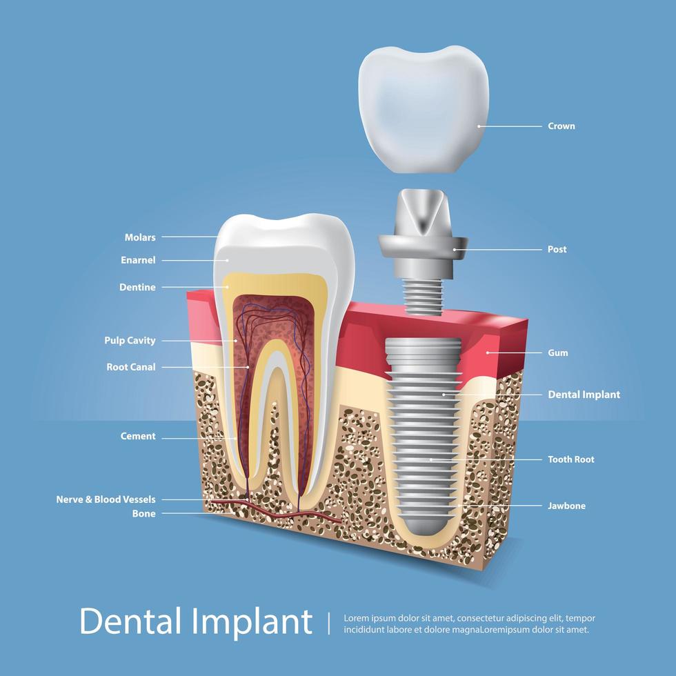 Ilustración de vector de dientes humanos e implantes dentales