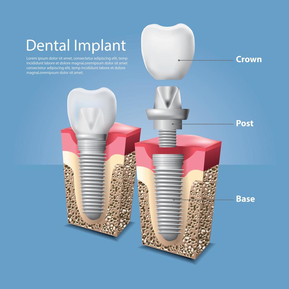 Ilustración de vector de dientes humanos e implantes dentales