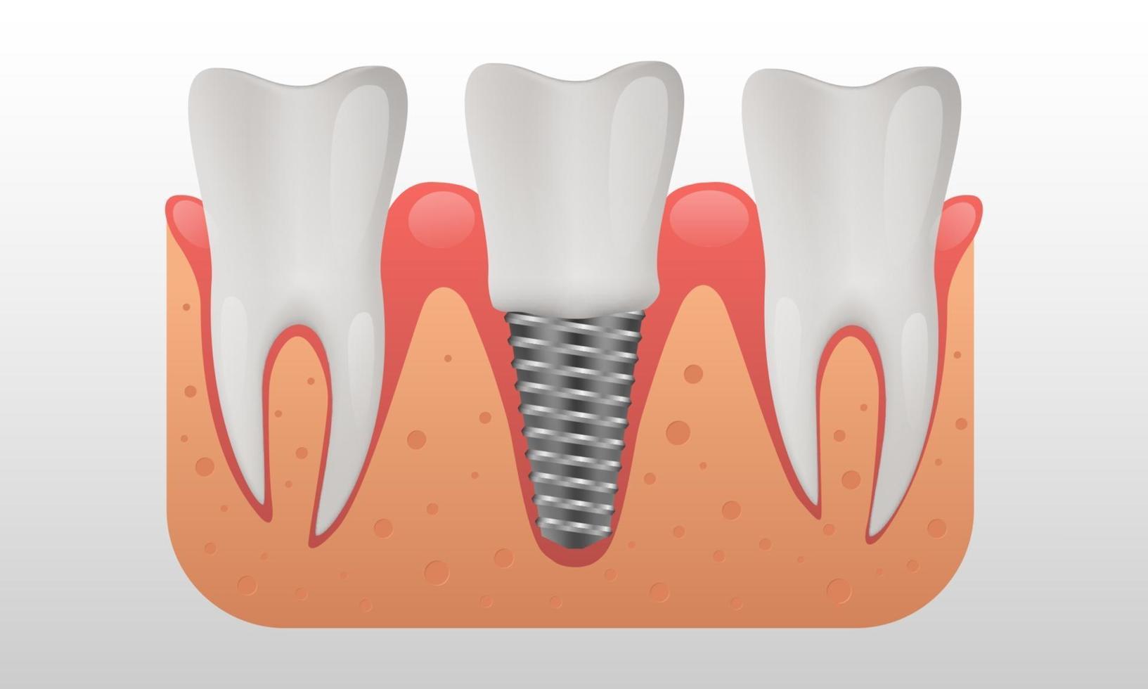 Dental implant structure human teeth and dental implant vector illustration