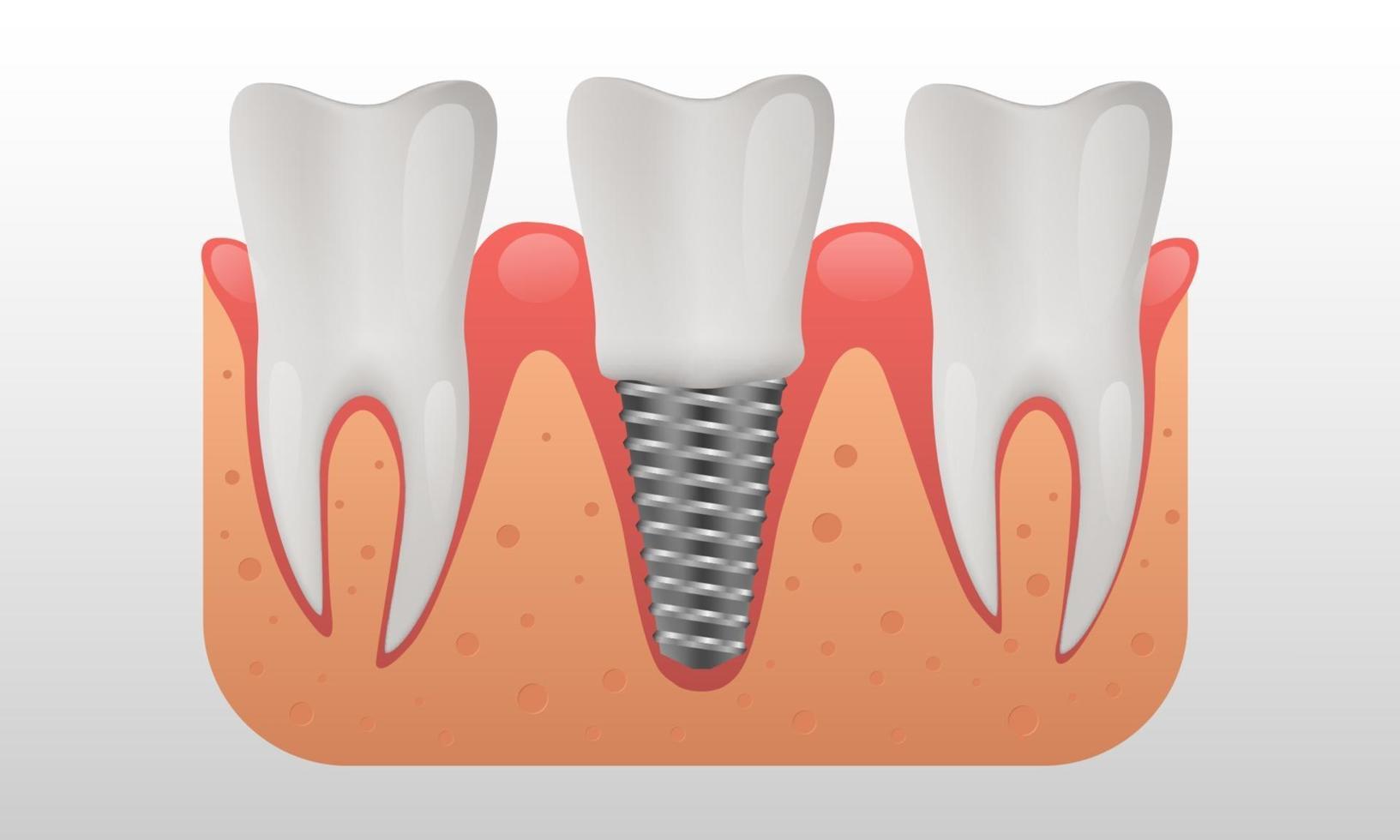 Estructura de implantes dentales dientes humanos e ilustración de vector de implantes dentales