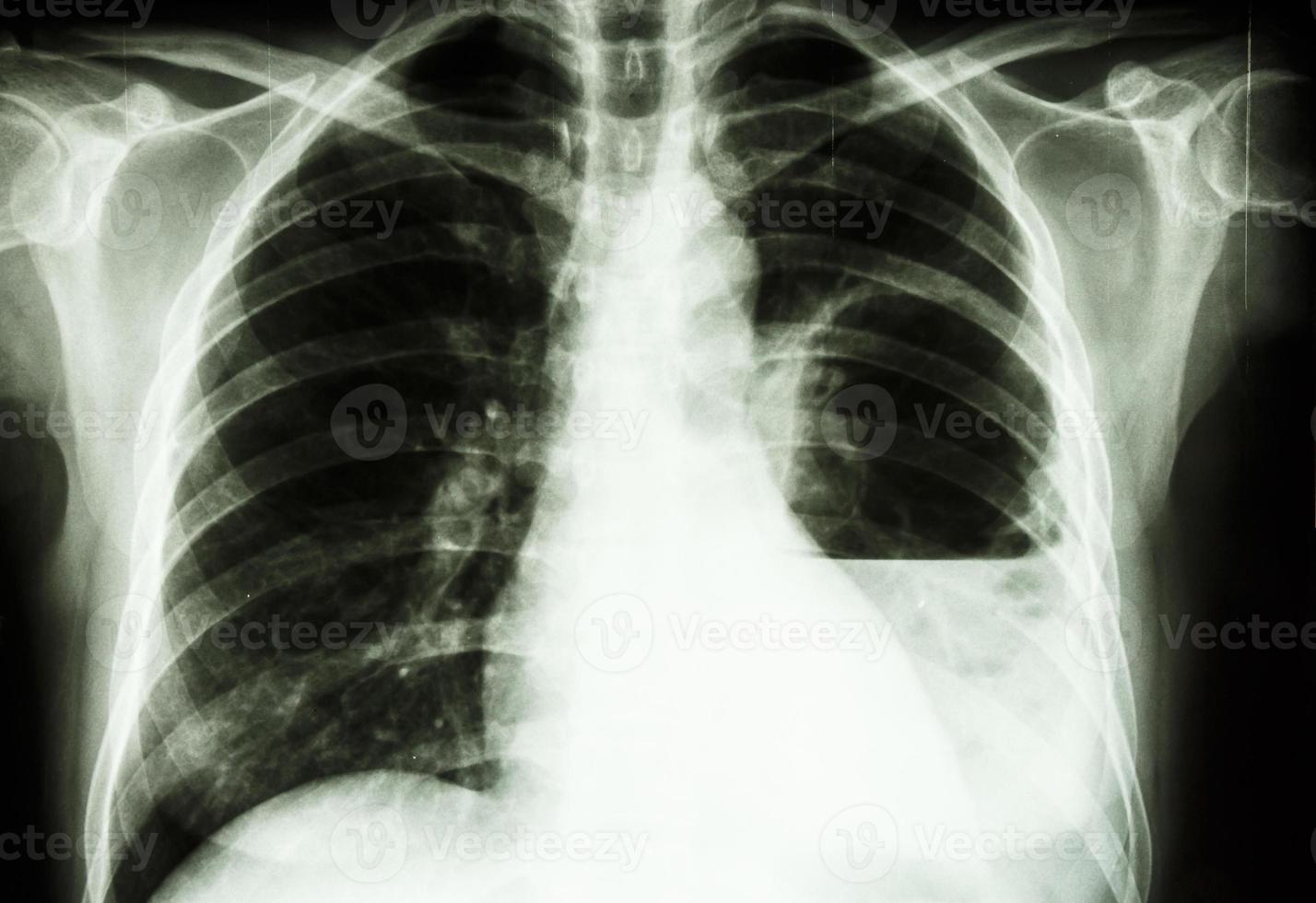 película de absceso pulmonar radiografía de tórax pa en posición vertical mostrar absceso pulmonar izquierdo foto