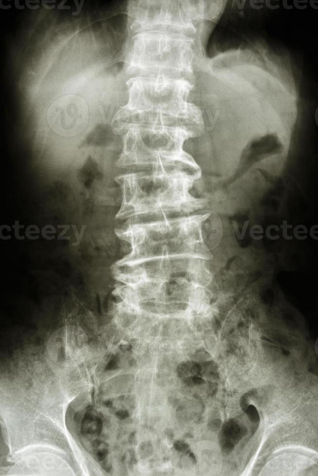 La radiografía de película de espondilosis de la columna lumbar muestra el cambio degenerativo del paciente anciano foto