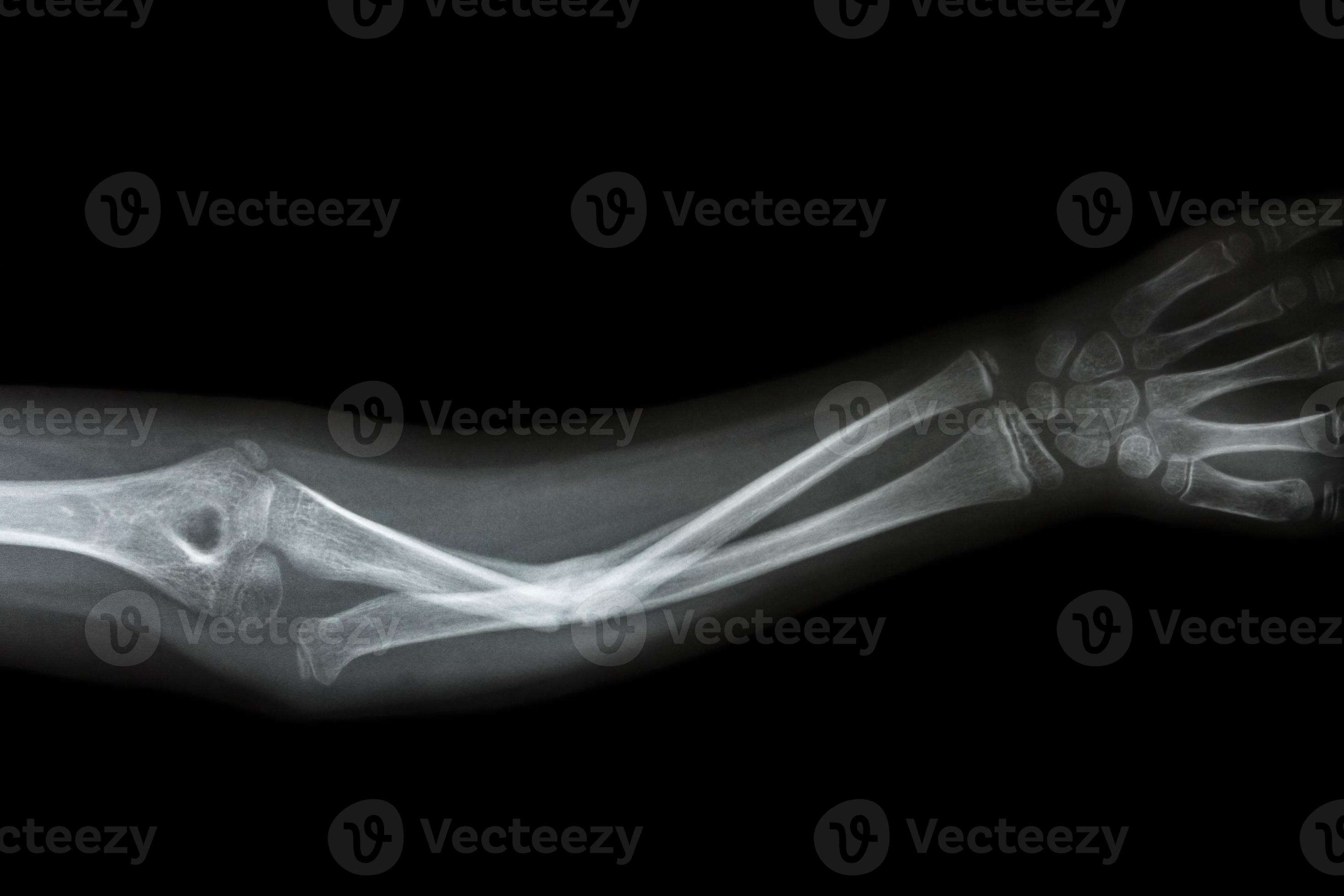 film x ray forearm AP show fracture shaft of ulnar forearm s bone