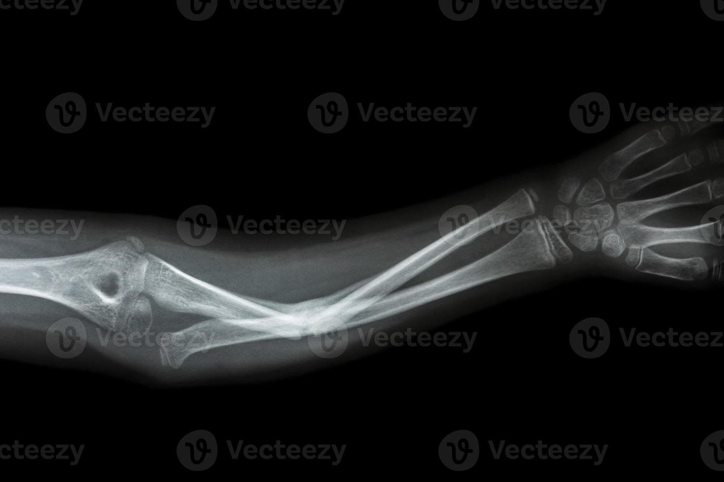 film x ray forearm AP  show fracture shaft of ulnar  forearm s bone photo