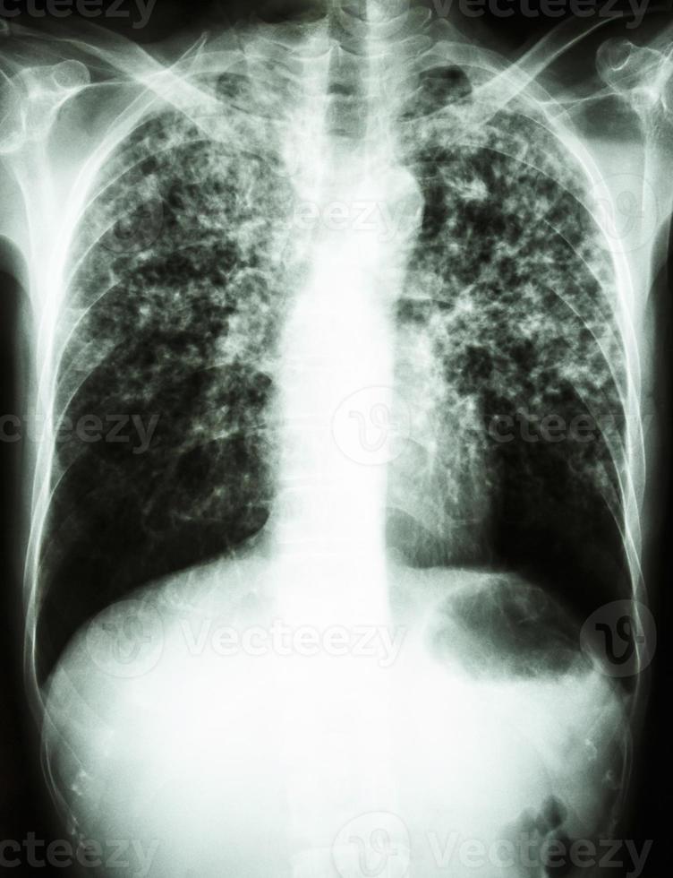 film chest x ray show interstitial infiltrate both lung due to Mycobacterium tuberculosis infection   Pulmonary Tuberculosis photo