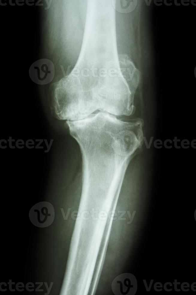 Película de rayos x rodilla ap de osteoartritis rodilla paciente oa rodilla foto