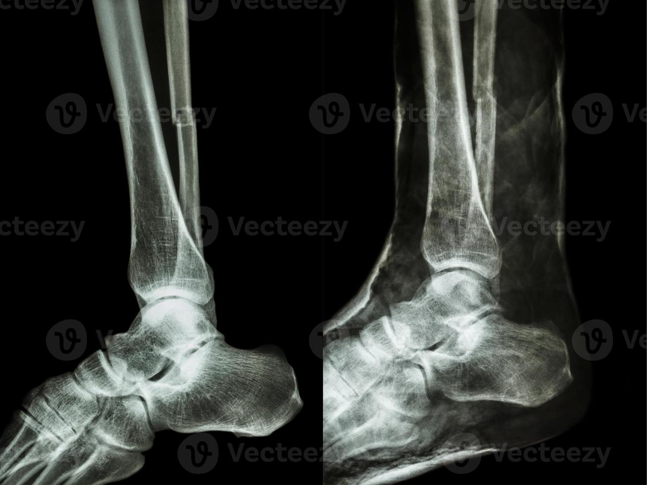 Left image   Fracture shaft of fibula calf bone    Right image  It was splinted with plaster cast photo