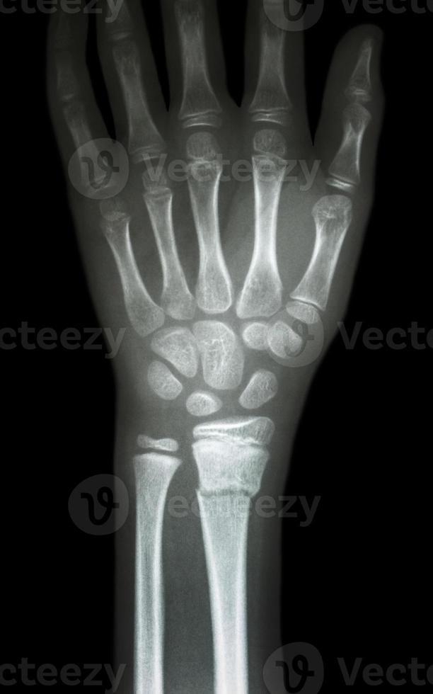 film x ray wrist show fracture distal radius  forearm s bone photo