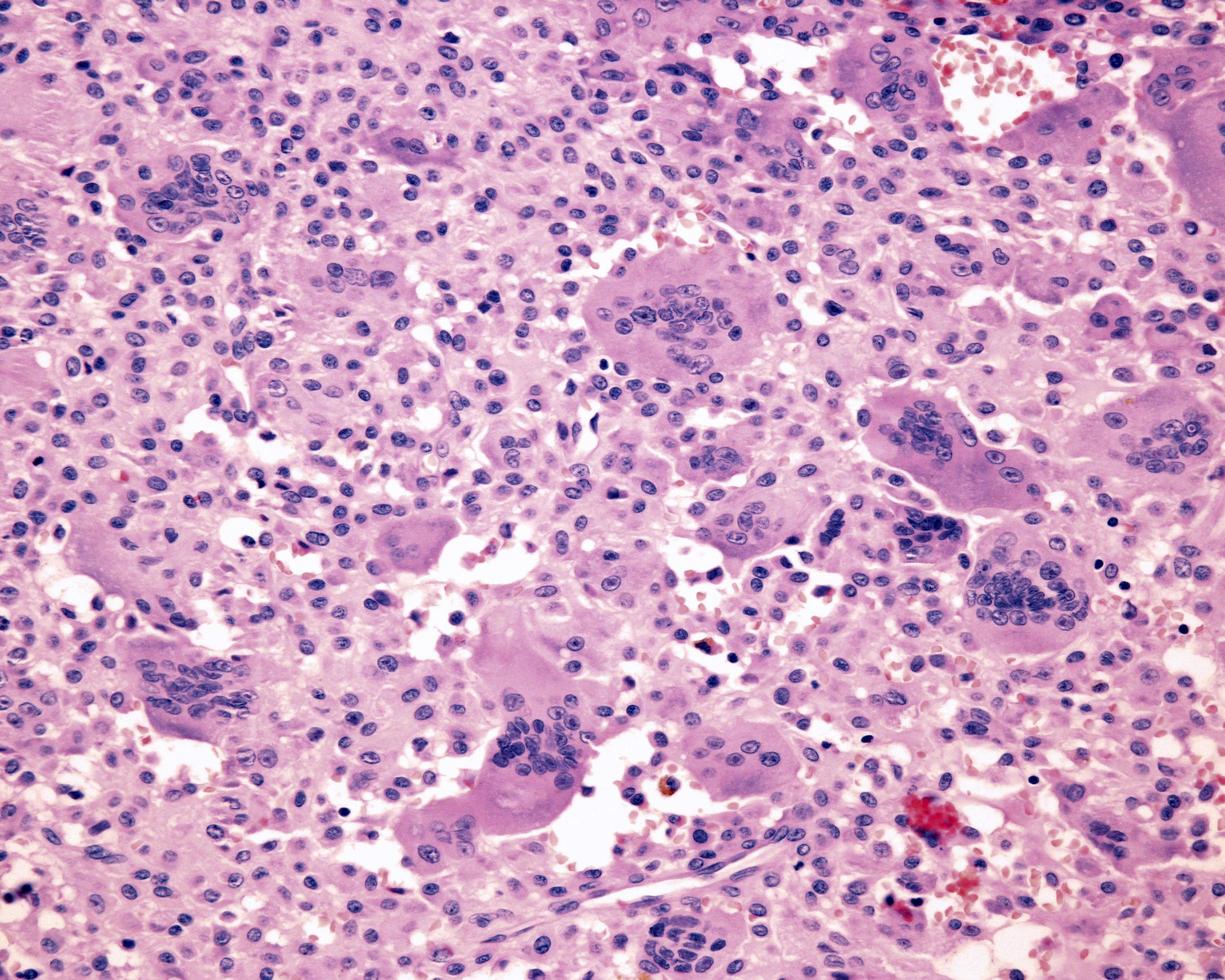 Multinucleated giant cells photo