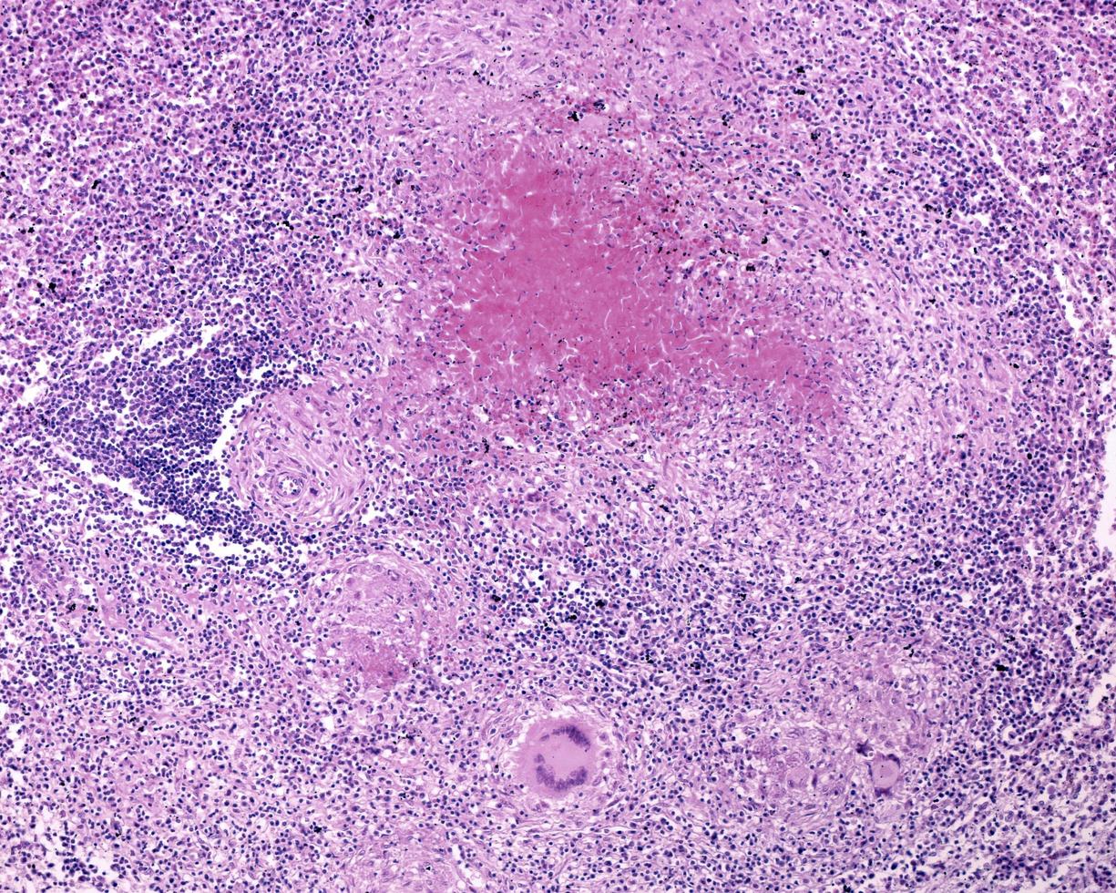 Human spleen Tuberculosis photo