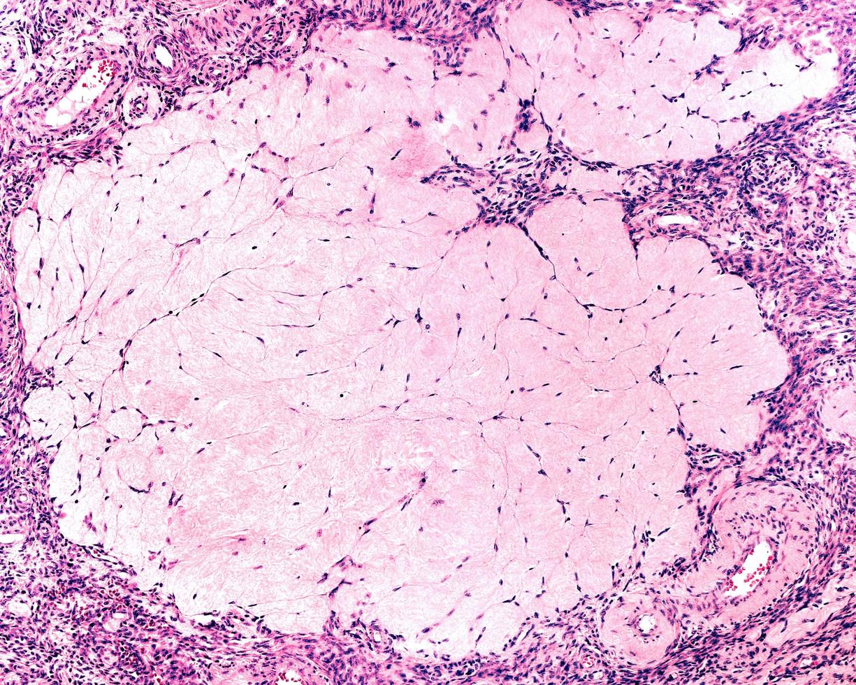 Ovary Corpus albicans photo