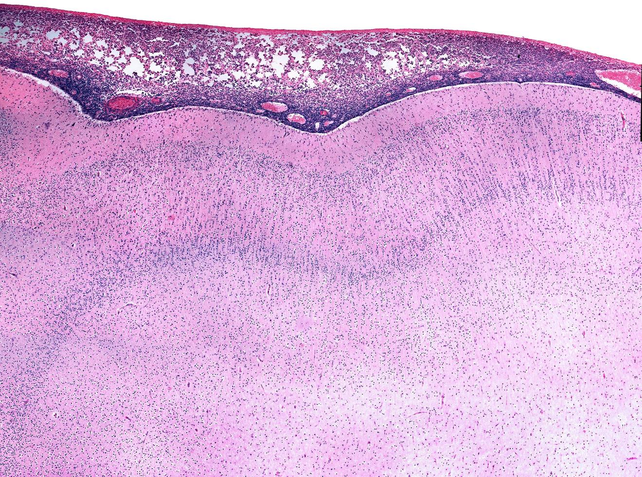 Acute meningitis human photo