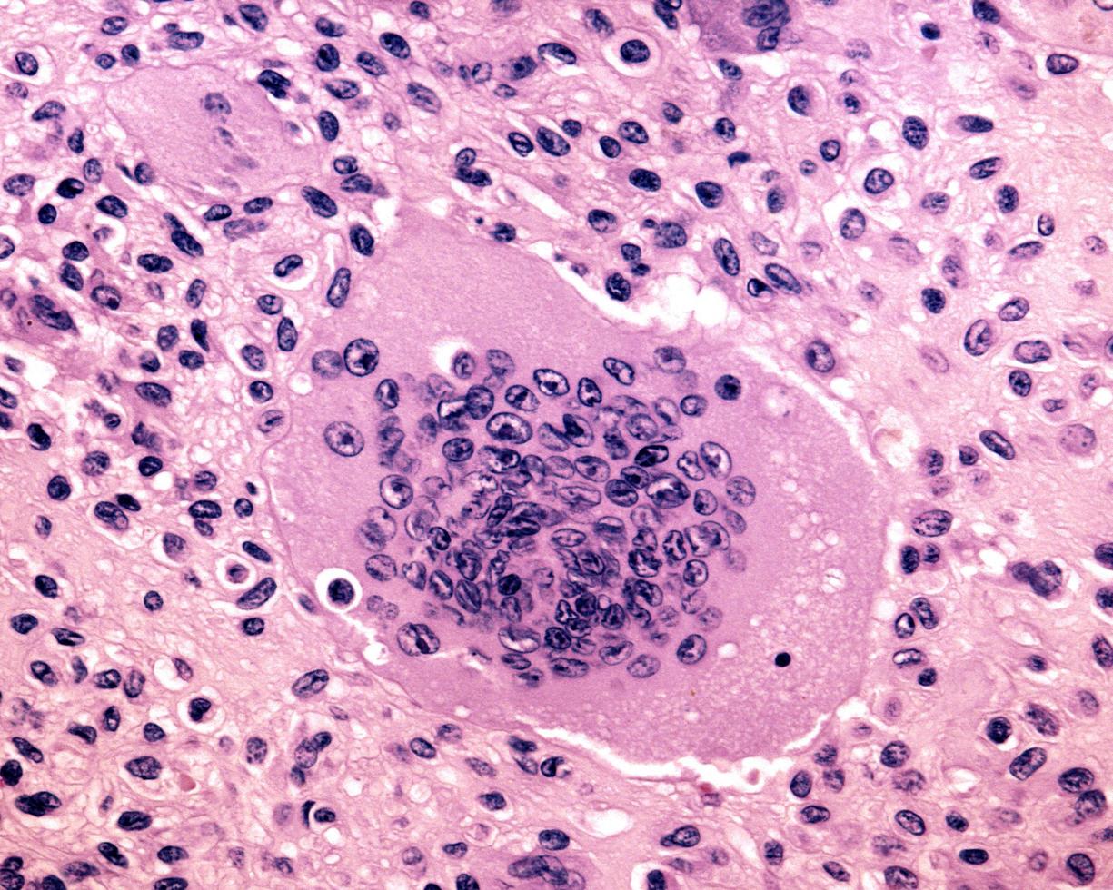 Mutinucleated giant cell photo