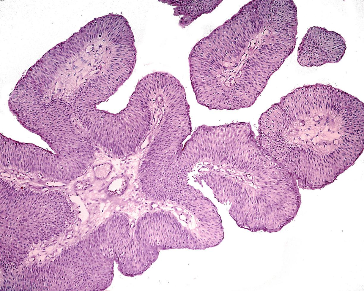 Urinary bladder papilloma photo