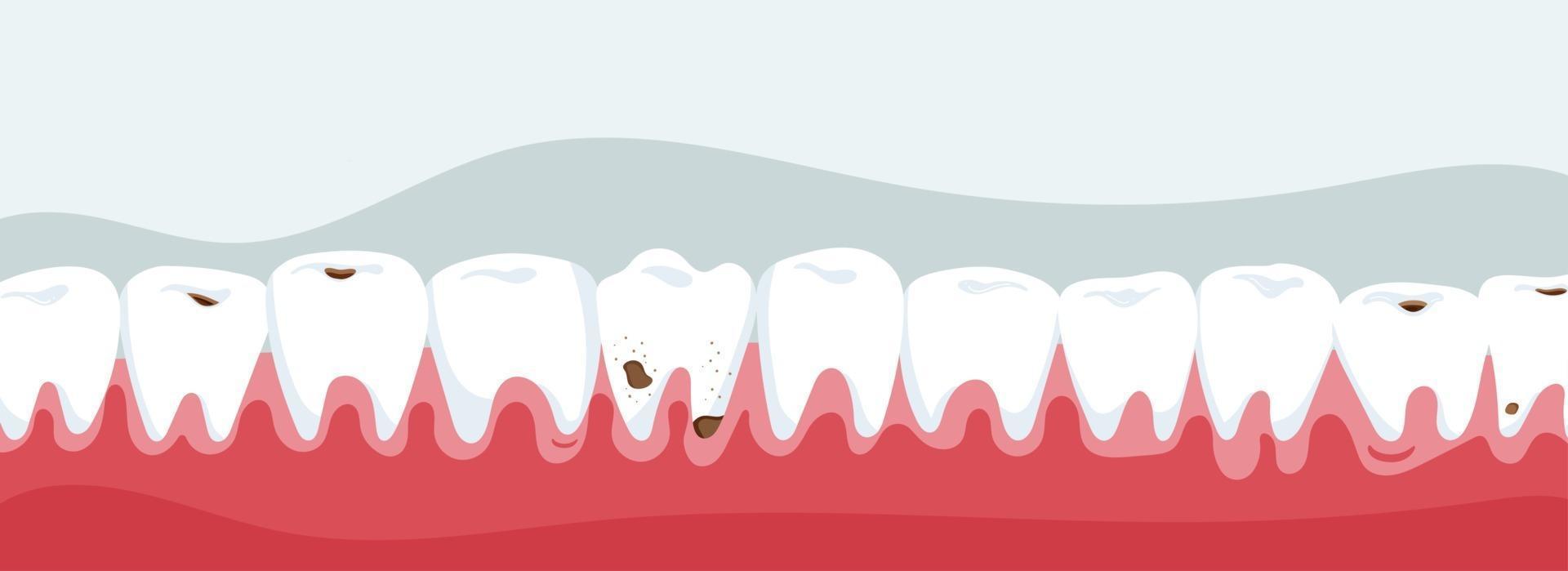 Jaw with teeth decay vector