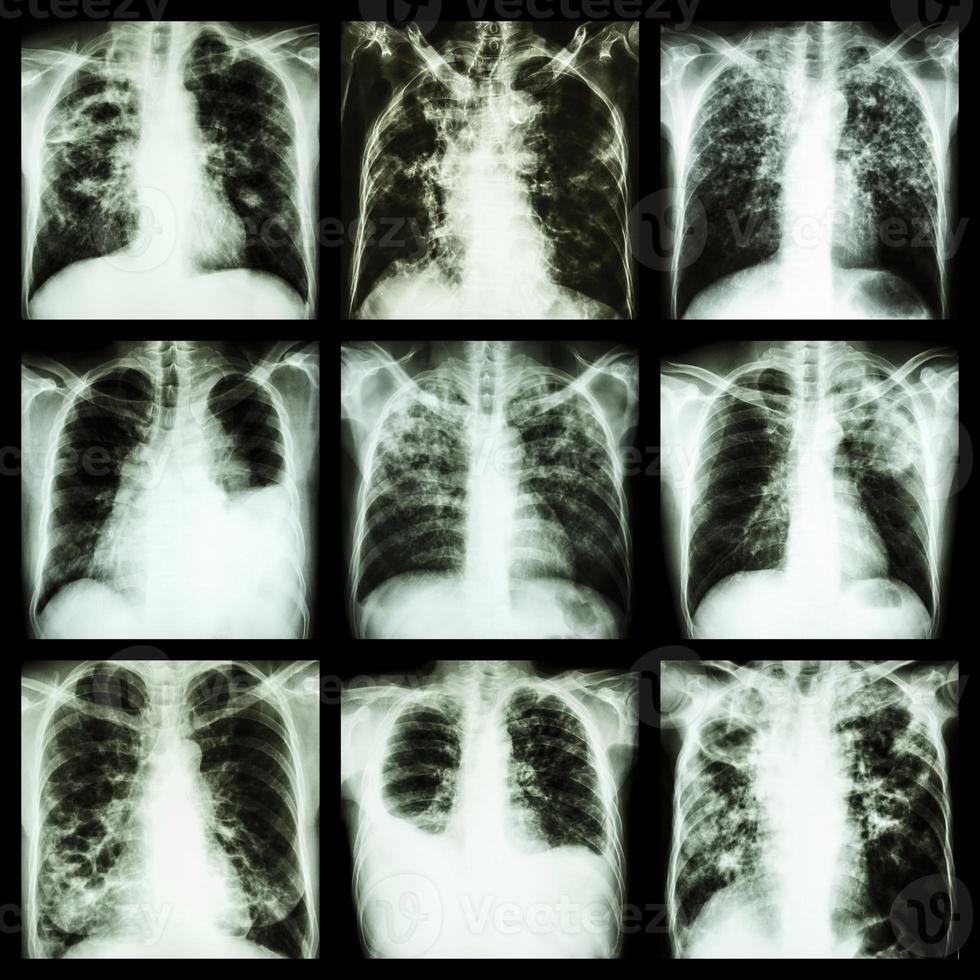 Collection of lung disease  Pulmonary tuberculosis  Pleural effusion  Bronchiectasis photo