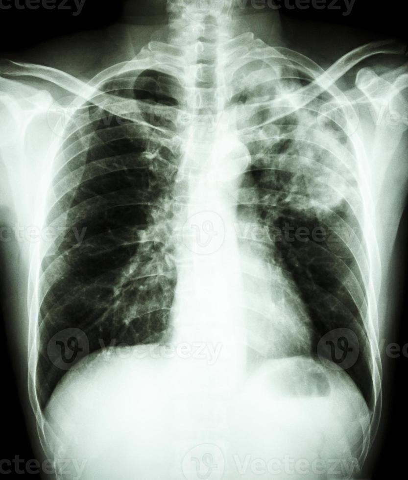 La radiografía de tórax de la película muestra un infiltrado alveolar en la parte superior del pulmón izquierdo debido a una infección por Mycobacterium tuberculosis tuberculosis pulmonar foto