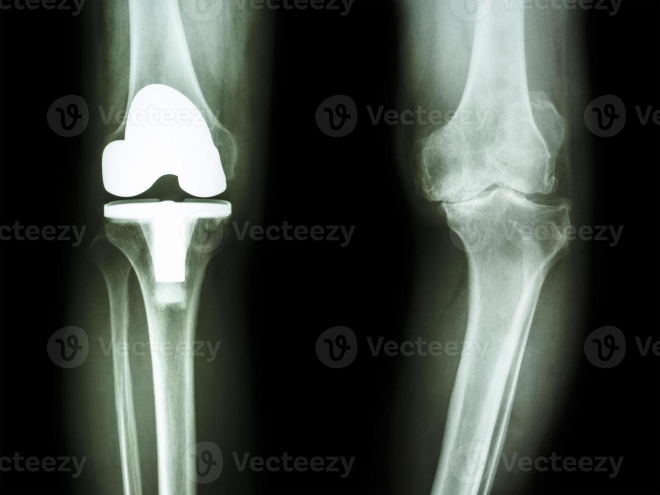 Radiografía de película de rodilla del paciente de rodilla con osteoartritis y articulación artificial foto