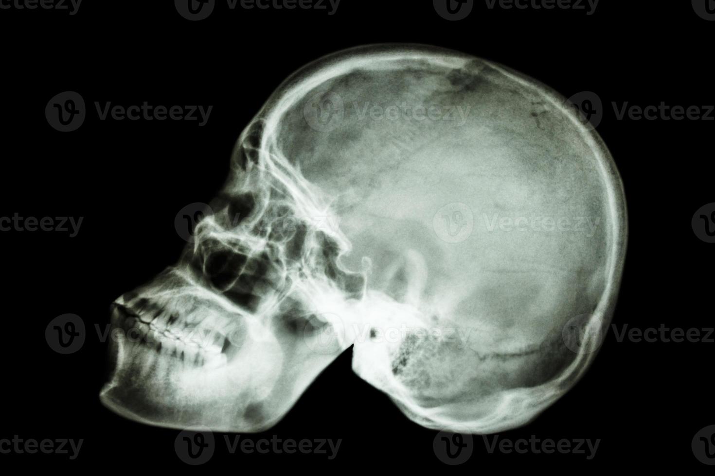 Película de rayos x cráneo humano normal s vista lateral asiática foto