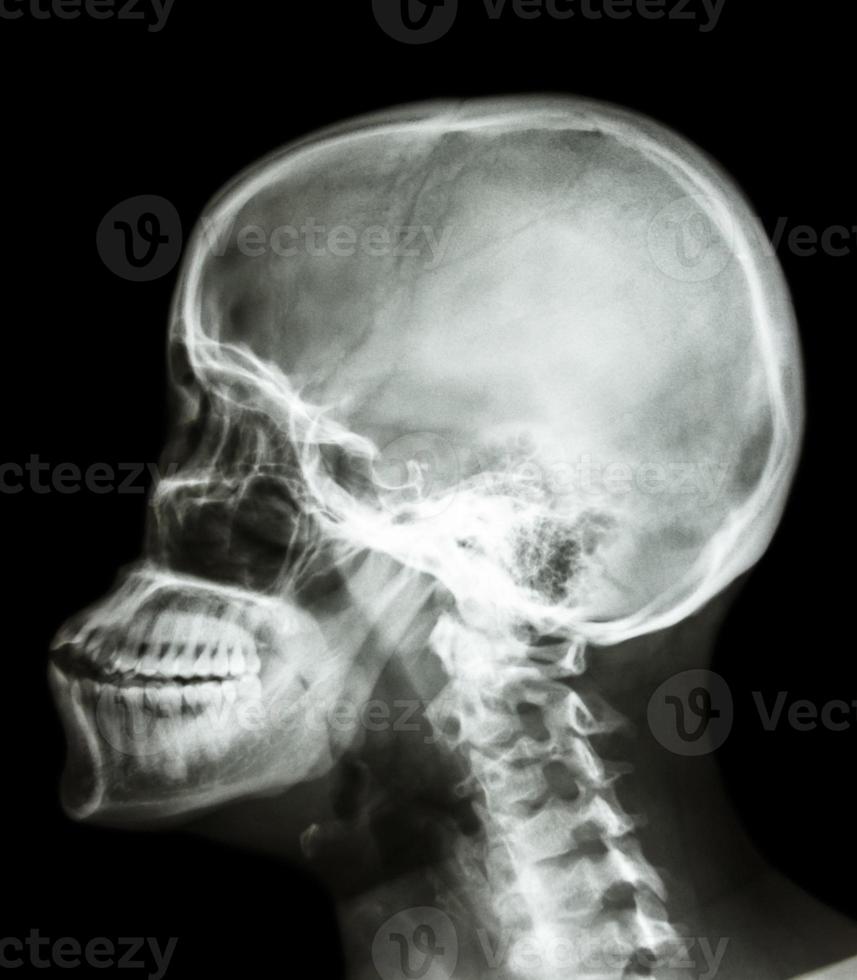 La radiografía de la película vista lateral del cráneo muestra el cráneo humano y la columna cervical foto