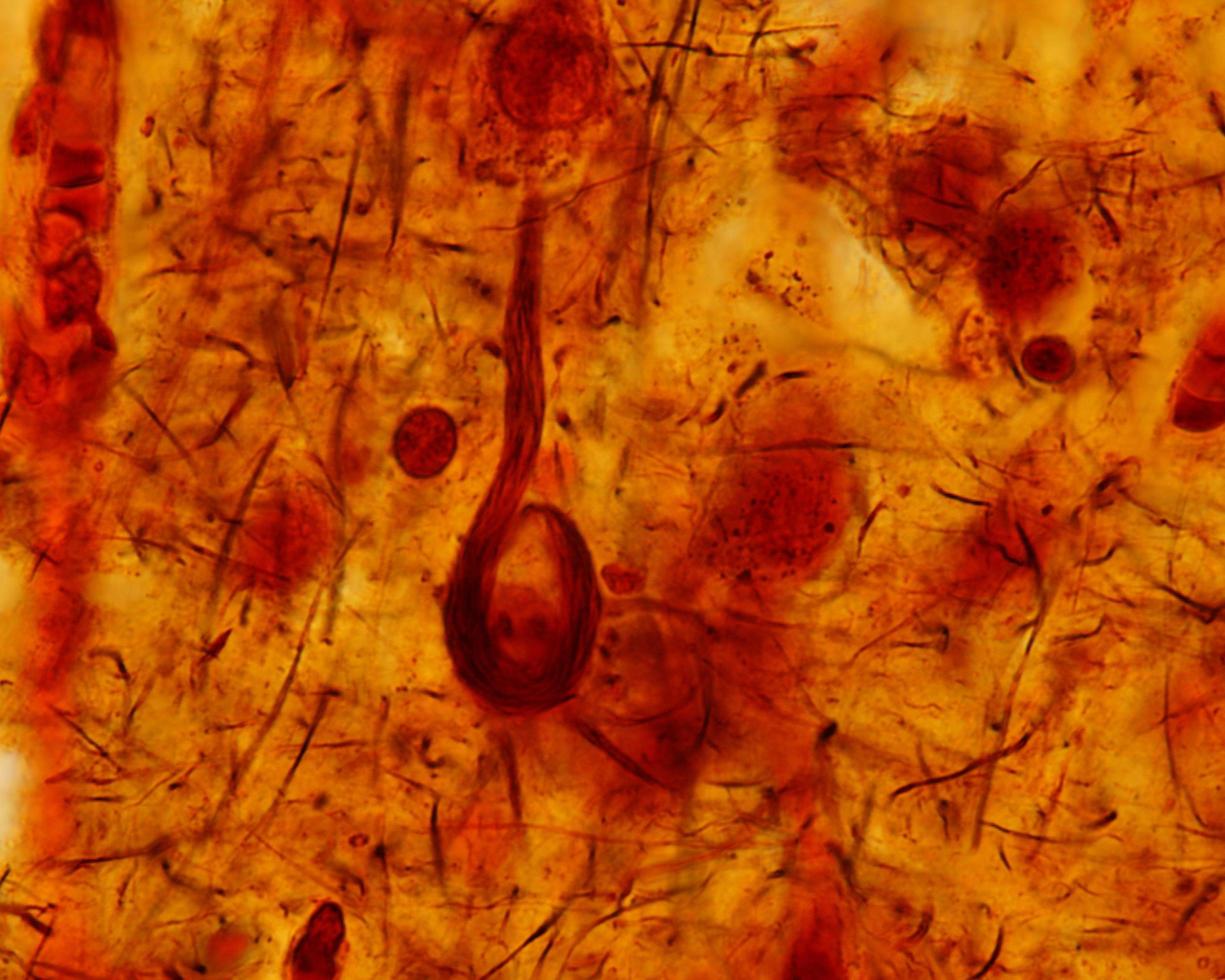 Alzheimer disease Neurofibrillary tangles photo