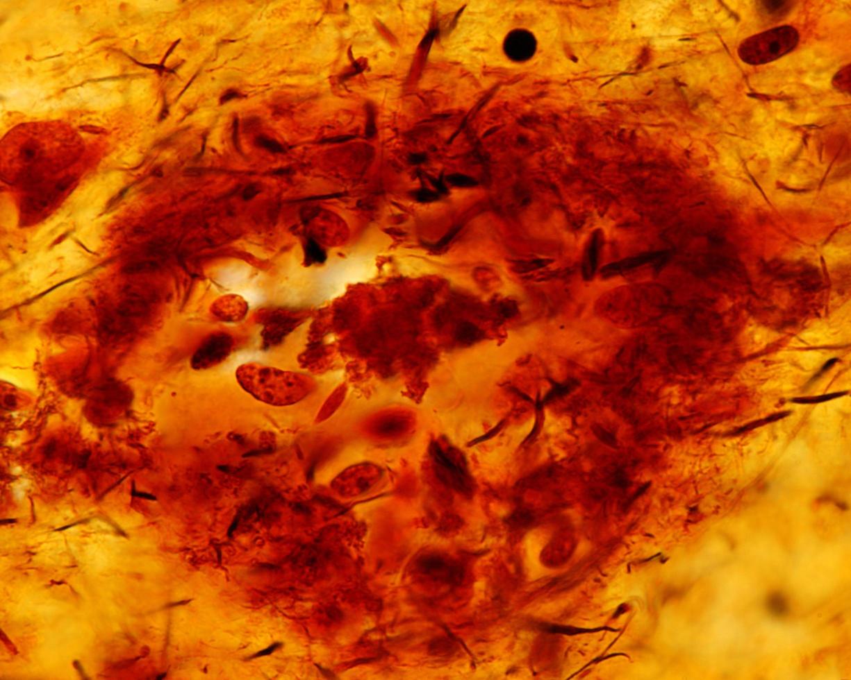 Senile plaques Alzheimer disease photo