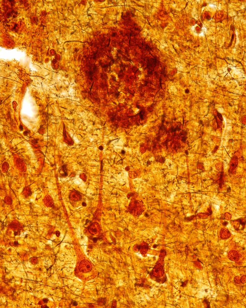 Senile plaques Alzheimer disease photo