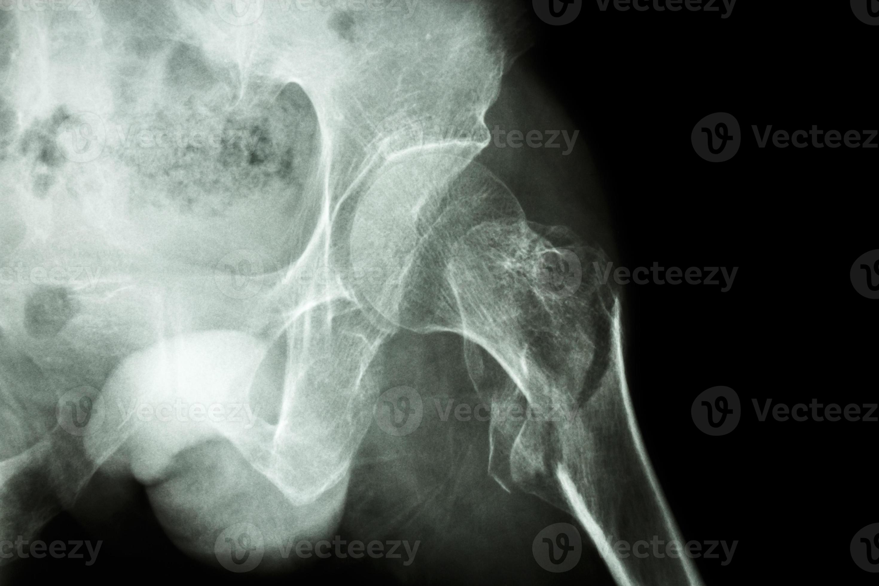 femur anatomy xray