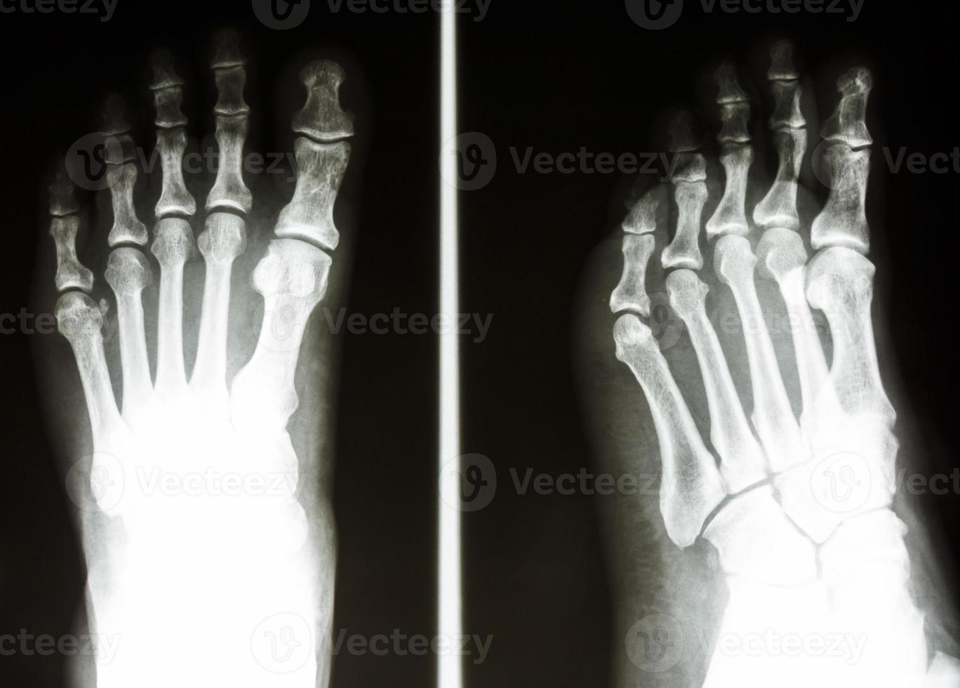 La radiografía de la película muestra el hueso normal del pie humano. foto