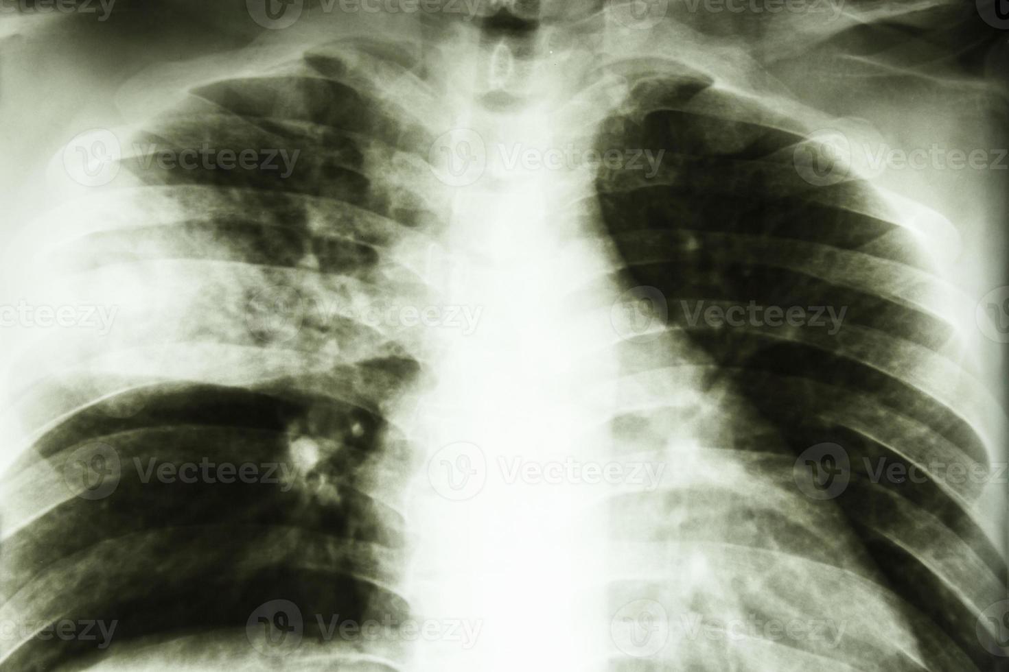 Film X ray show patchy infiltrate at right middle lung  Lobar pneumonia  from Mycobacterium tuberculosis infection  Pulmonary tuberculosis photo