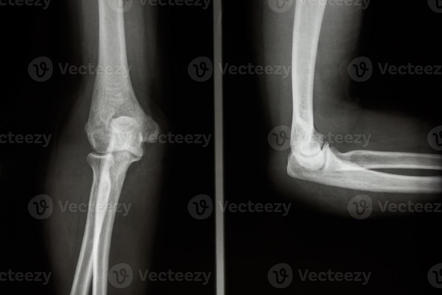 film xray elbow AP and Lateral view show normal human s elbow 2493647