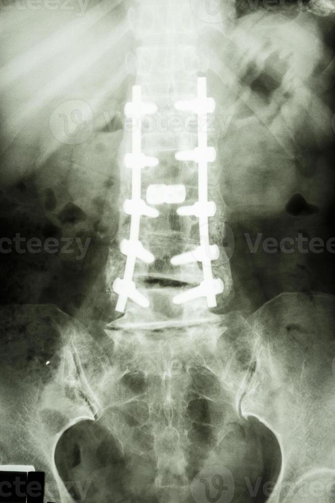 Película de rayos X muestran la columna lumbar con fijación de tornillos pediculares en pacientes con espondilolistesis foto