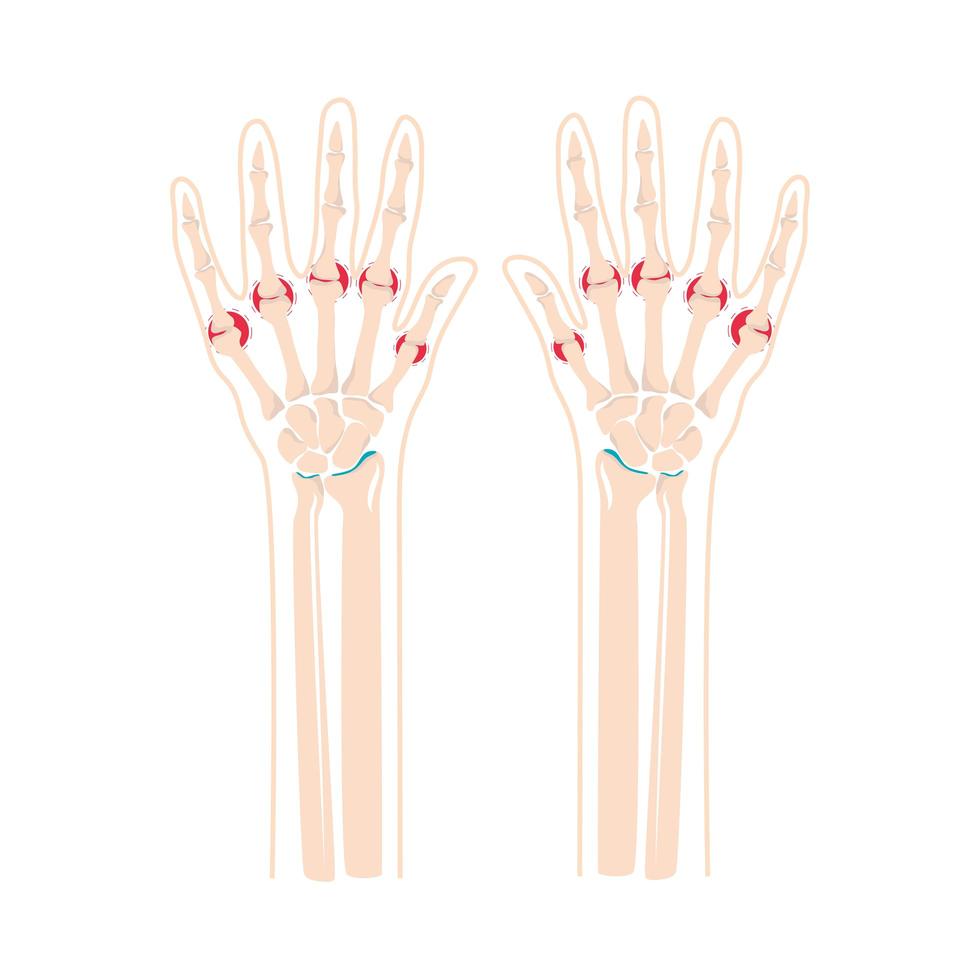rheumatism bones in hands vector