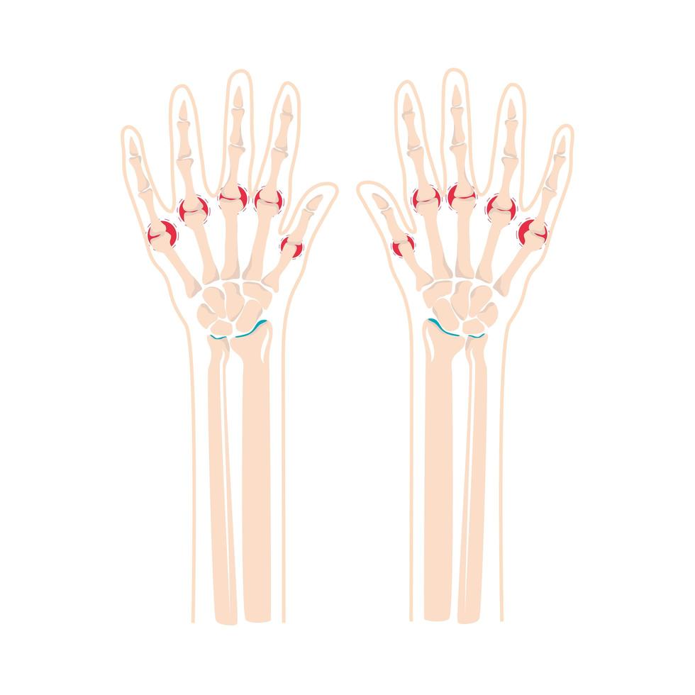 rheumatism bones in hands vector