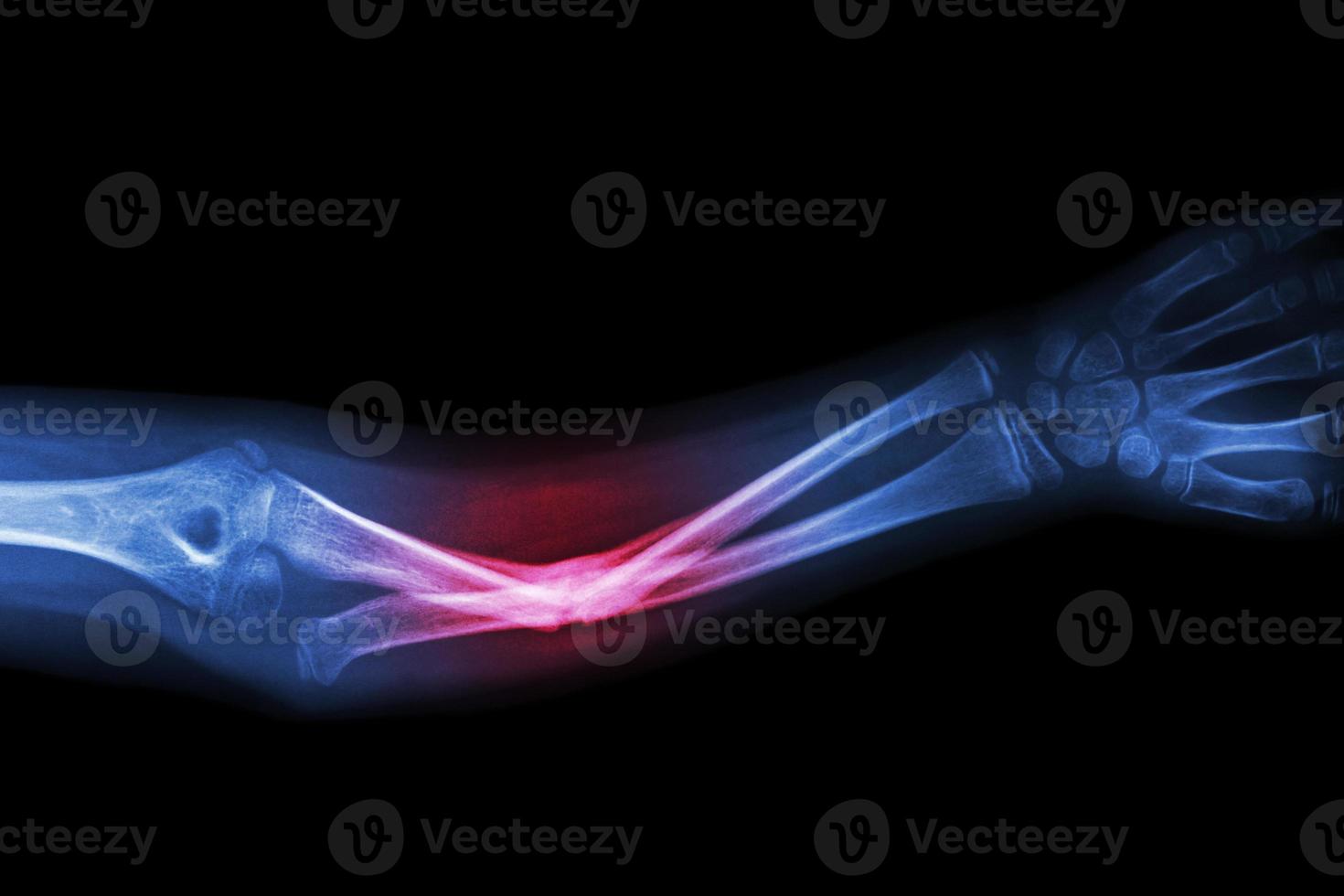 Film X ray fracture ulnar bone  forearm bone photo