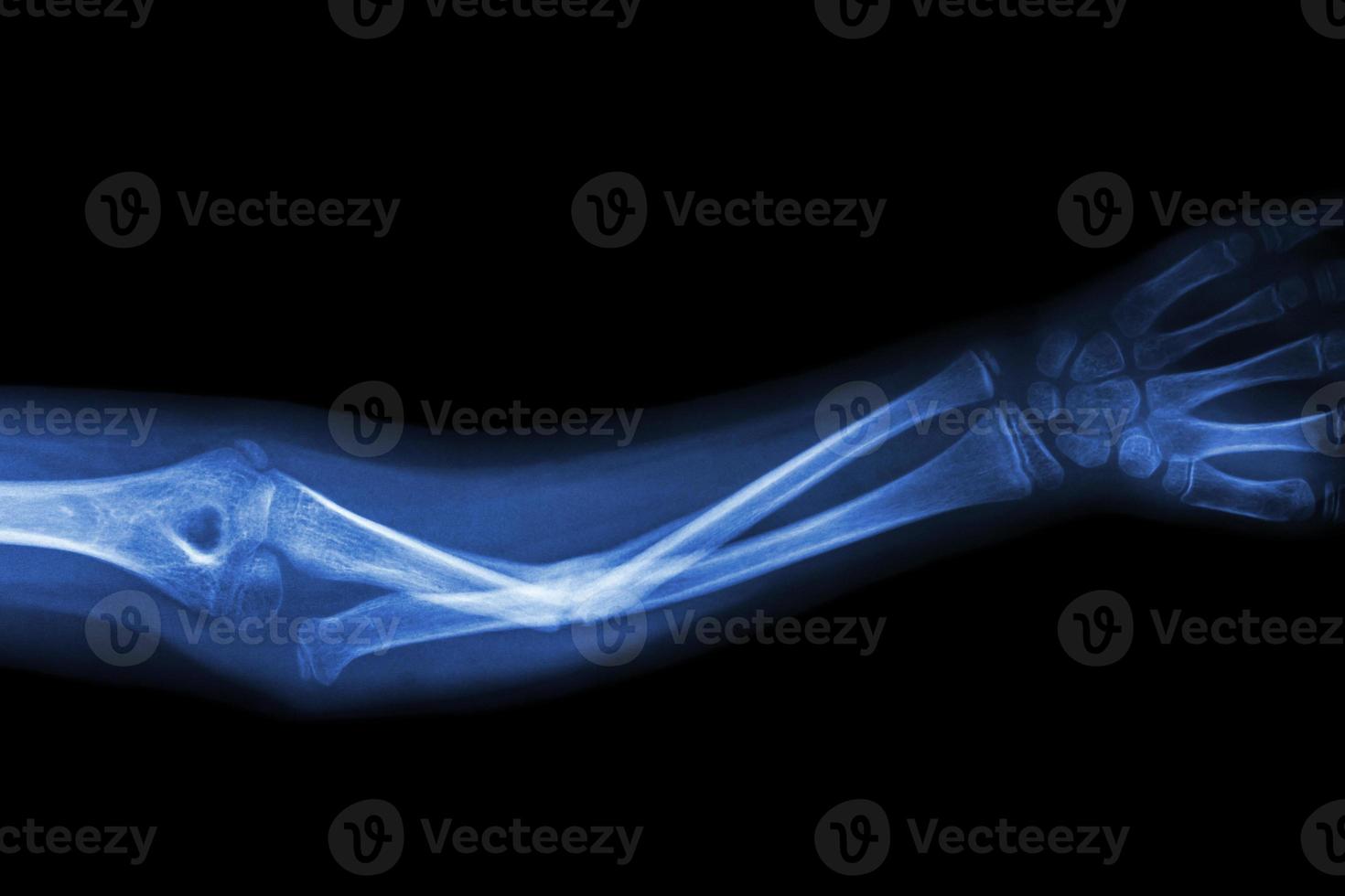 Film X ray fracture ulnar bone  forearm bone photo