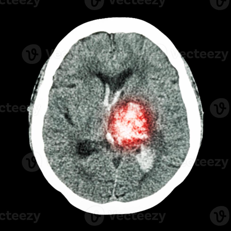 CT brain  show left thalamic hemorrhage  Hemorrhagic stroke photo