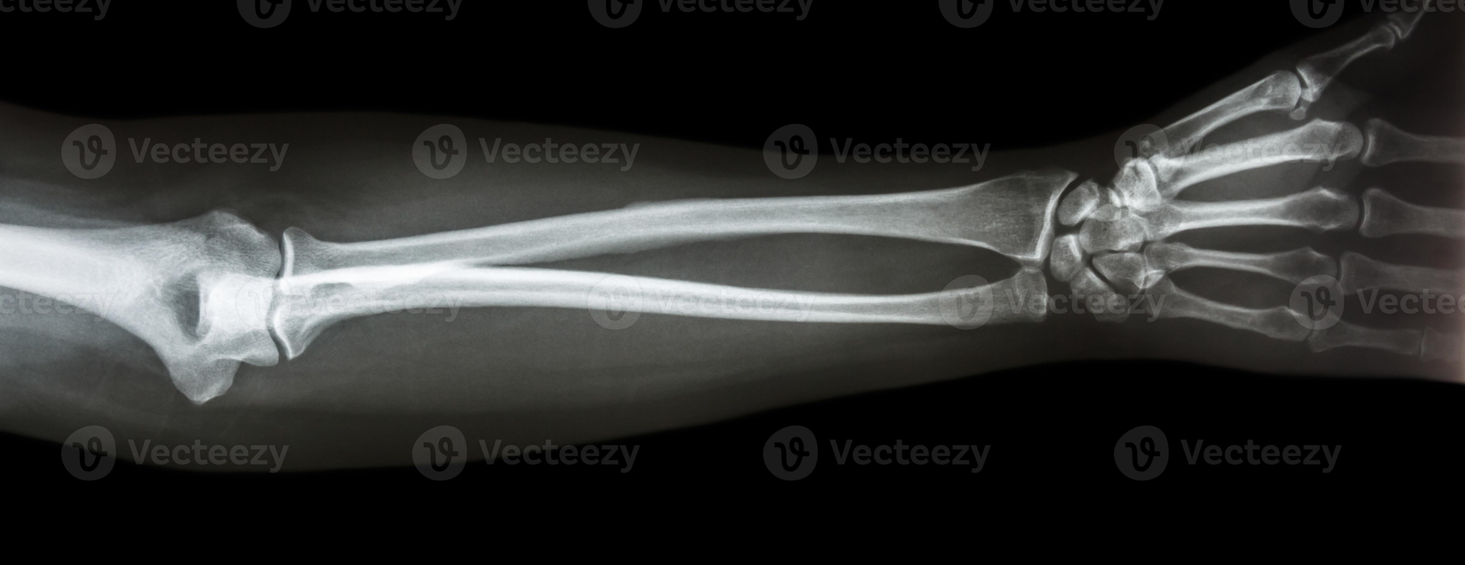 film x ray forearm AP antero posterior view 2499792 Stock Photo at Vecteezy
