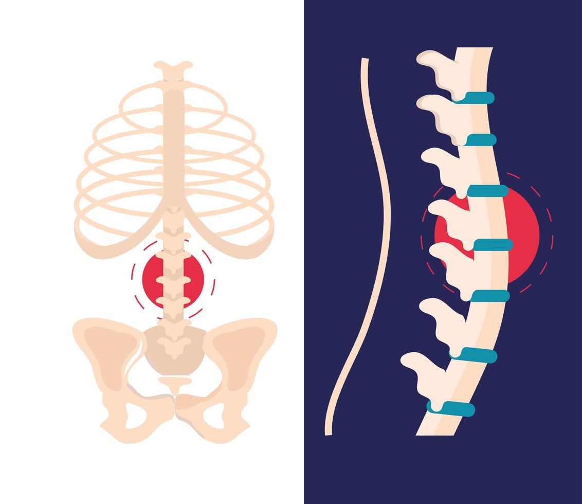 artritis reumatología columna vertebral vector