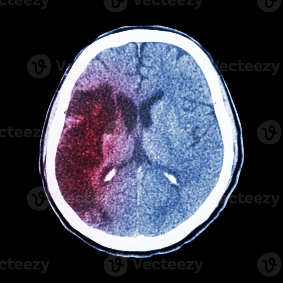 CT brain  show Ischemic stroke  hypodensity at right frontal parietal lobe photo