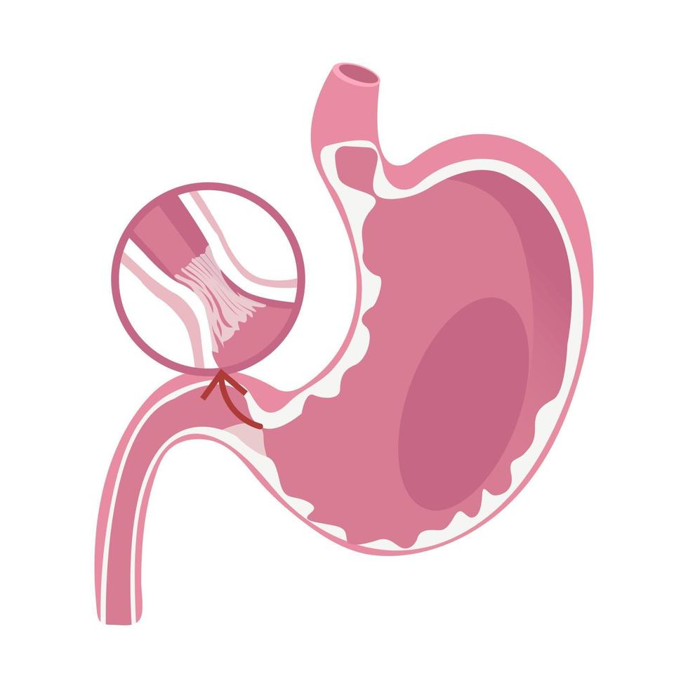 Illustration of Pyloric Stenosis disease vector