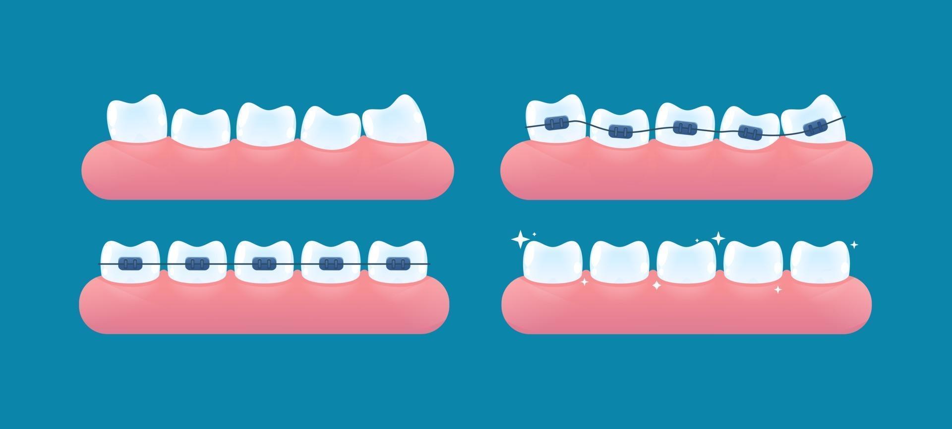 Alignment of teeth and bite correction with the help of braces system vector