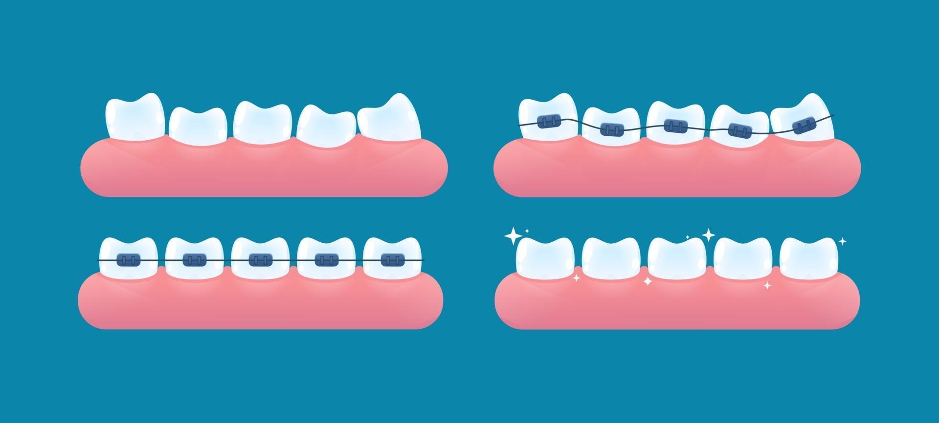 alineación de los dientes y corrección de la mordida con la ayuda del sistema de tirantes vector