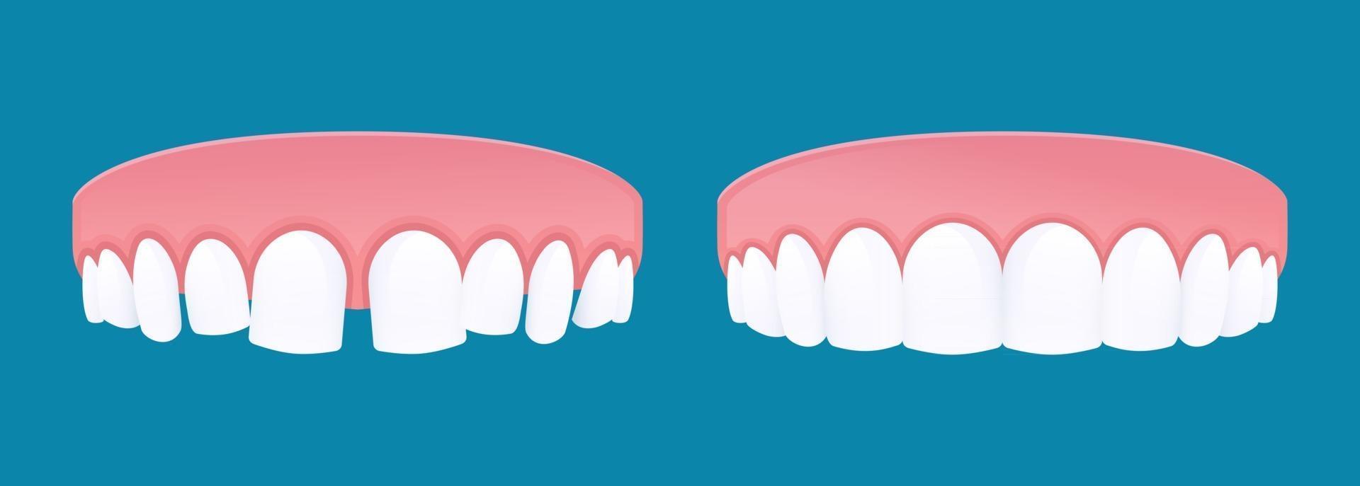 Diastema teeth with dental spacing and healthy teeth vector