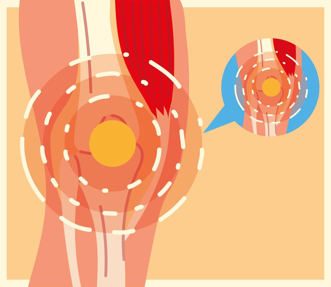 rheumatology leg pain vector